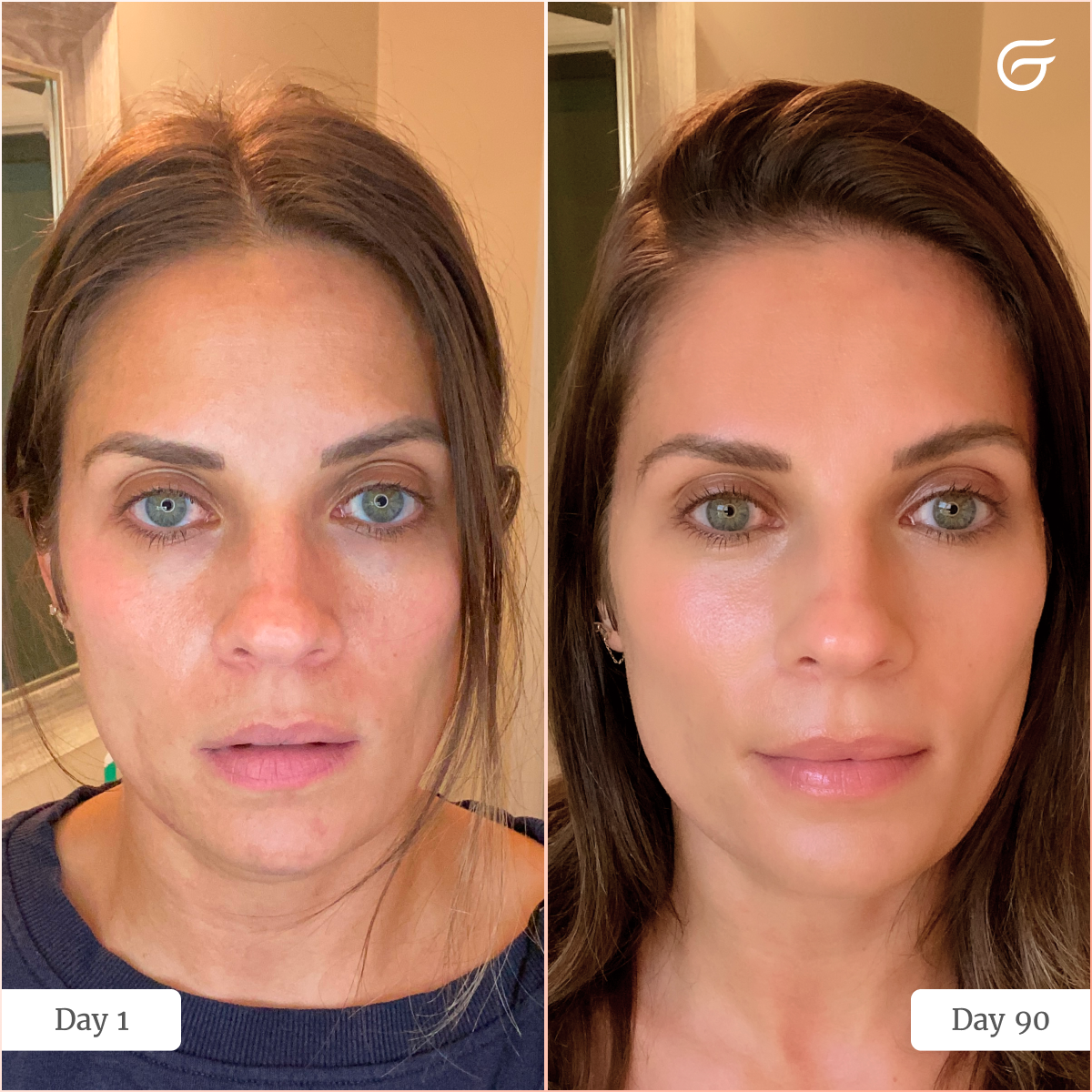 GlowUp™ LED Light Therapy Face Mask